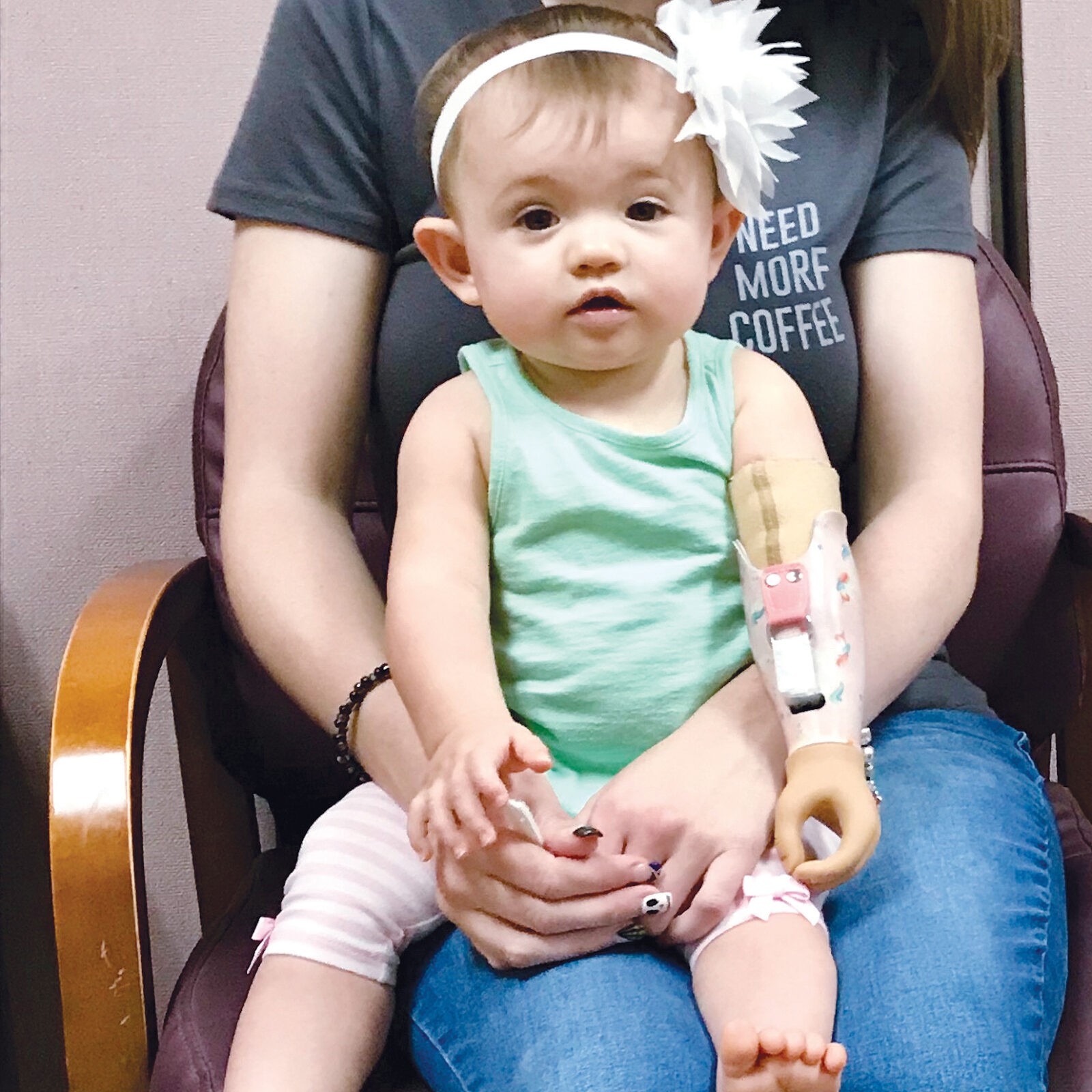 baby-girl-prosthetic baby girl with a prosthetic arm