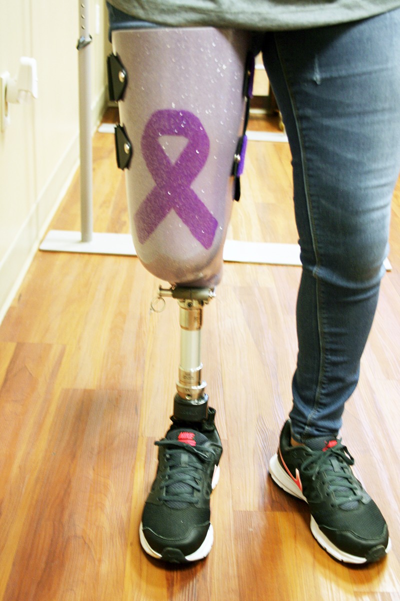 patricia2-patient-testimonial woman with a prosthetic leg walking