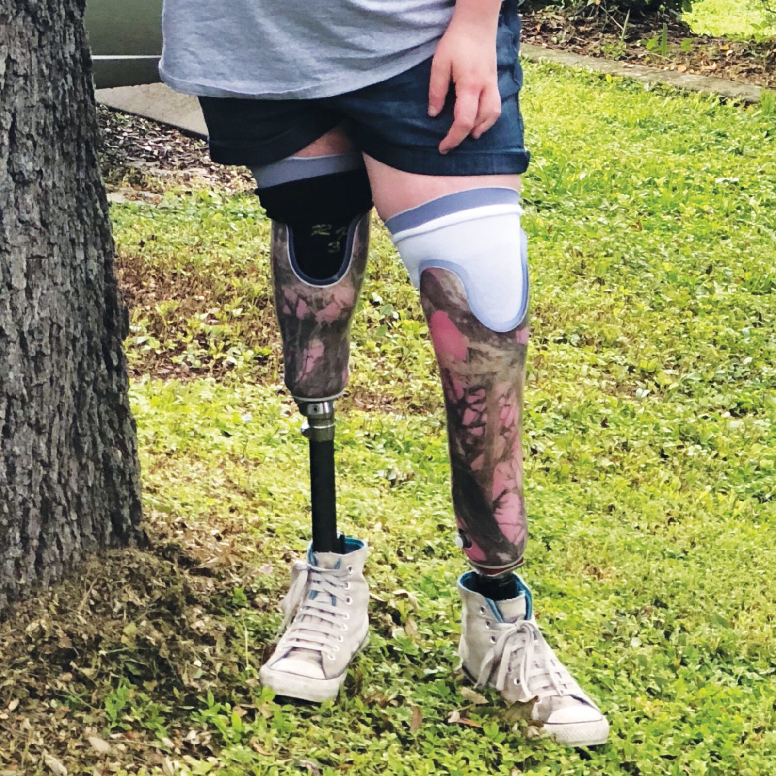 teenager-prosthetic teenager with prosthetic legs